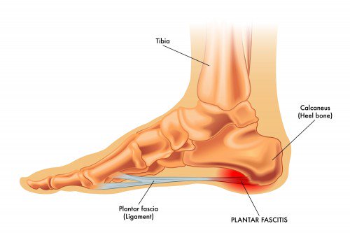 PLANTER FASCIITIS (HEEL PAIN) WHAT IS PLANTER FASCIITIS:
Planter fasciitis is one of the most common causes… Read more