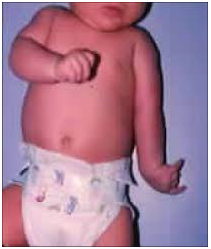 WHAT IS BRACHIAL PLEXUS:

The brachial plexus is a complex of nerves which originate from the neck and goes to the shoulder. These nerves control the muscles of arm, hand, shoulder,… Read more