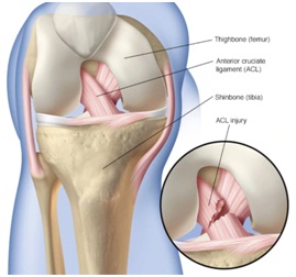 acl injury