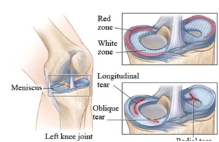 meniscus injury
